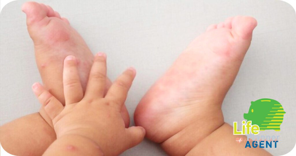 002.โรคมือเท้าปาก2